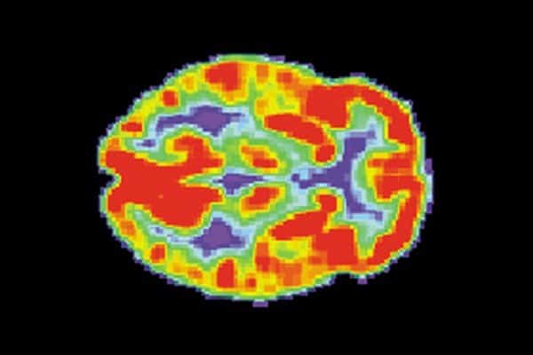 PET_Normal_brain PET_Normal_brain