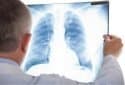 New research may explain severe viral lung infections