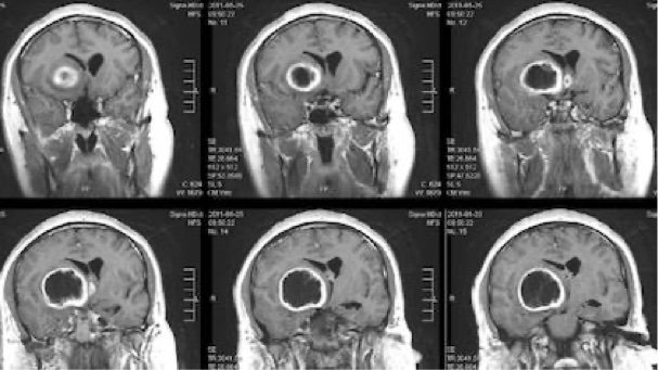 230093_web - UTW brain tumor