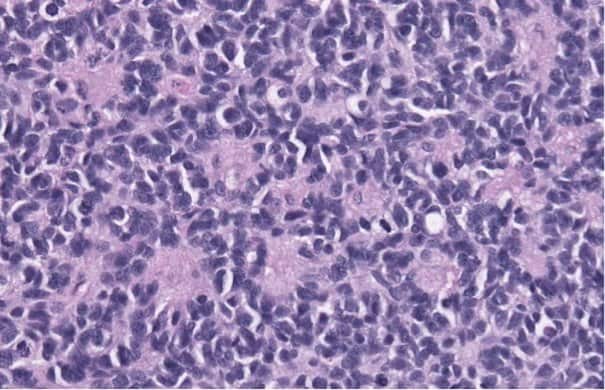 640px-Medulloblastoma_with_rosettes 640px-Medulloblastoma_with_rosettes