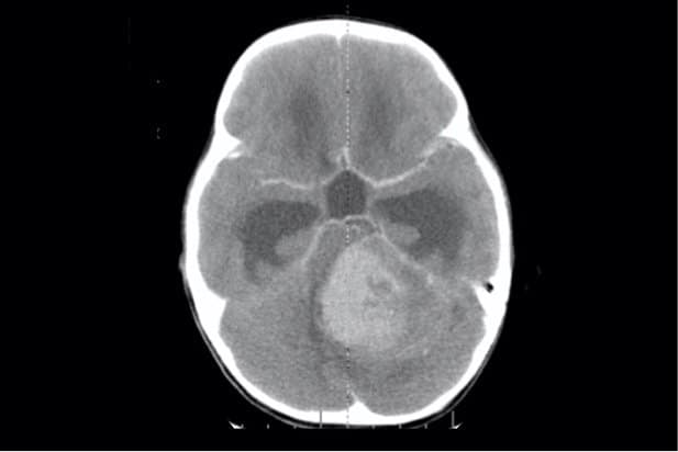 Medulloblastom_CT Medulloblastoma CT scan