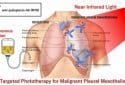 Shining light on a malignant lung cancer