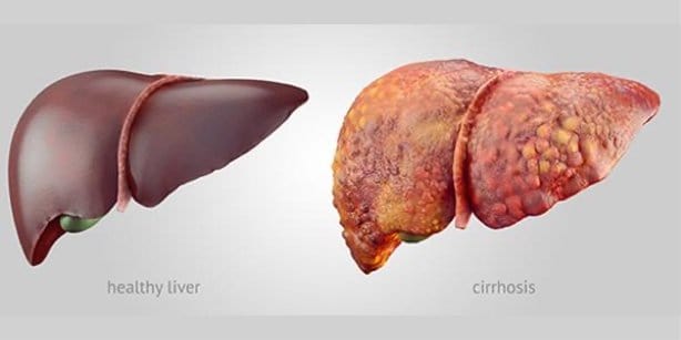 Cirrhotic liver - National Institute of Diabetes and Digestive and Kidney Diseases Cirrhotic liver - National Institute of Diabetes and Digestive and Kidney Diseases