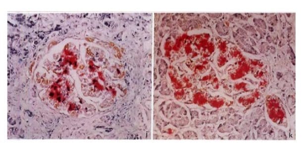 Immunohistochemistry_and_histochemistry_triple_staining_showing_reduced_pancreatic_beta_cells_(red)_in_pancrease_with_severe_fibrosis(left_image)_comparing_with_the_normal_control_(right_image)