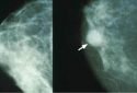 Targeting drug-resistant breast cancer with estrogen