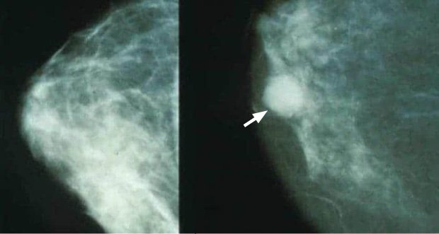 breast mammogram