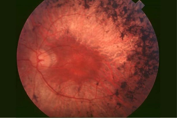 560px-Fundus_of_patient_with_retinitis_pigmentosa,_mid_stage 560px-Fundus_of_patient_with_retinitis_pigmentosa,_mid_stage