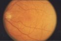 New treatment targets found for blinding retinal disease