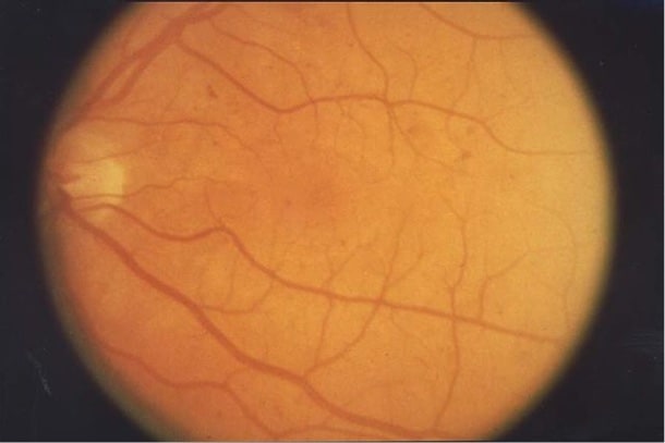 640px-Fundus_retinopathy_EDA03 retinopathy
