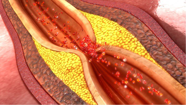 Depositphotos_112248694_s-2019-sciencepics coronary artery plaque