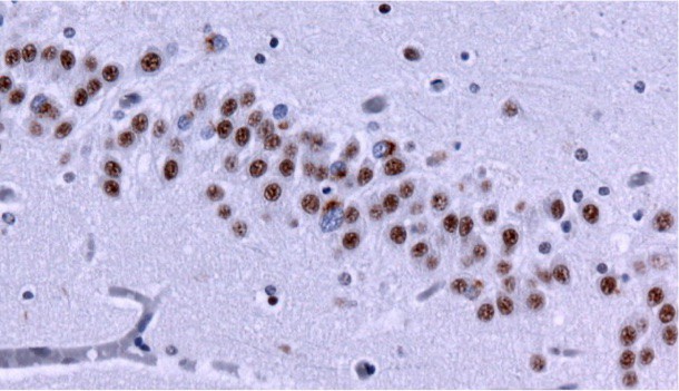 640px-FTLD_TSP43_hippocampus 640px-FTLD_TSP43_hippocampus