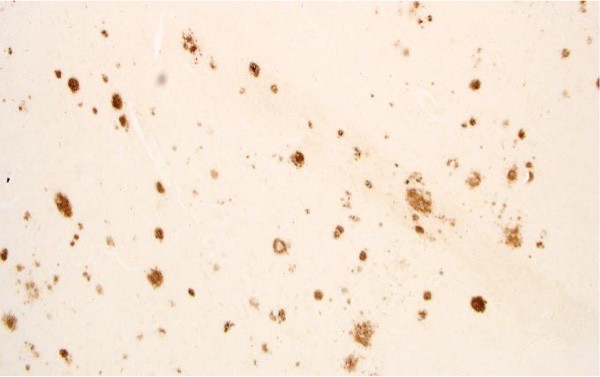 Amyloid plaques - RMIT University Amyloid plaques - RMIT University