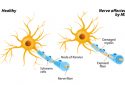 Anti-inflammatory therapy shows promise in slowing progression of multiple sclerosis