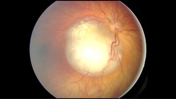 Fundus_retinoblastoma Fundus_retinoblastoma