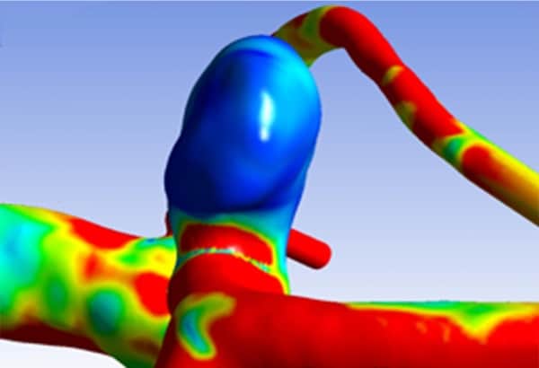 Aneurysm - UNIGE-HUG Aneurysm - UNIGE-HUG