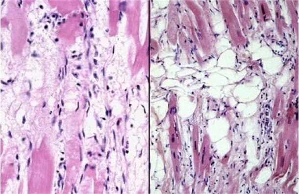 Arrhythmogenic_right_ventricular_cardiomyopathy_-_histology Arrhythmogenic_right_ventricular_cardiomyopathy_-_histology