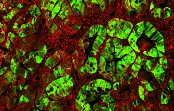 Colon tumor - Birchmer Lab - MDC Colon tumor - Birchmer Lab - MDC