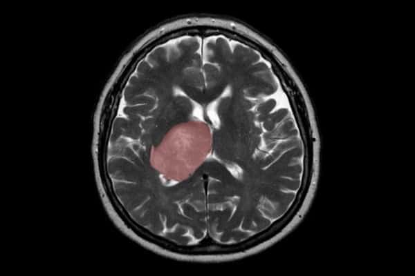 Tumor-promoting immune cells retrained to fight most aggressive type of brain cancer