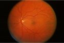 Ophthalmology exam – Beetham Eye Institute – Joslin Diabetes Center