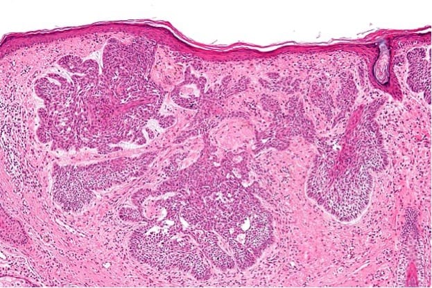 640px-Basal_cell_carcinoma_-_2_-_intermed_mag