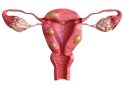 Safe and effective oral treatment for uterine fibroids