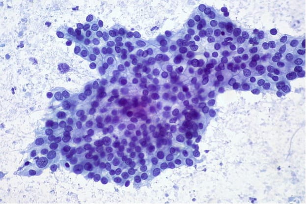 640px-Adenocarcinoma_of_Pancreas,_FNA_(5558060087) 640px-Adenocarcinoma_of_Pancreas,_FNA_(5558060087)