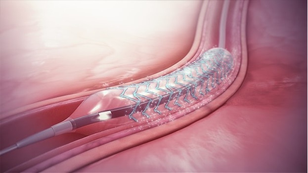 640px-Drug-eluting_stent 640px-Drug-eluting_stent