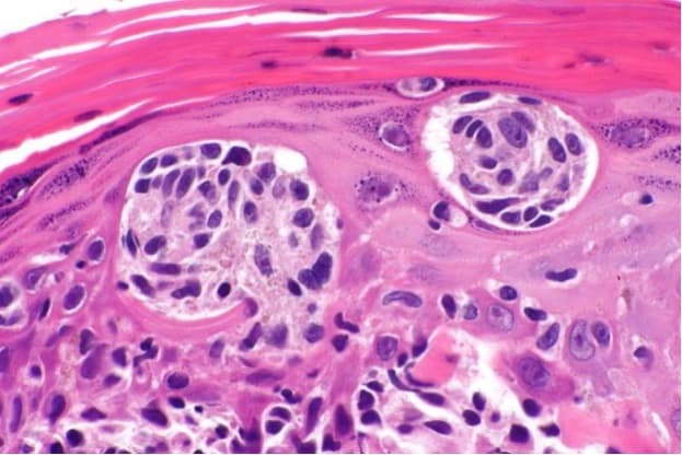 640px-Malignant_melanoma_in_situ_-_alt_--_very_high_mag 640px-Malignant_melanoma_in_situ_-_alt_--_very_high_mag
