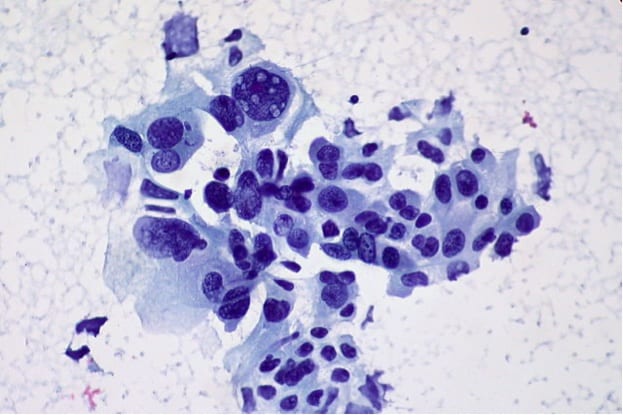 640px-Non-small_cell_carcinoma_-_FNA_(5998093938) 640px-Non-small_cell_carcinoma_-_FNA_(5998093938)