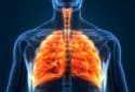 New drug effective against lung cancers caused by common genetic error