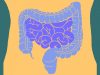 C. difficile may drive some colorectal cancers