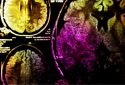 Preventing the long-term effects of traumatic brain injury