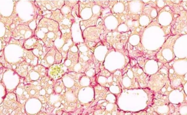 Revealing the mystery behind non-alcoholic fatty liver disease