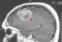 Fighting brain cancer at its root