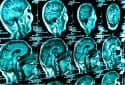 New method eradicates deadly glioblastoma brain tumors by ‘starving’ them of energy source