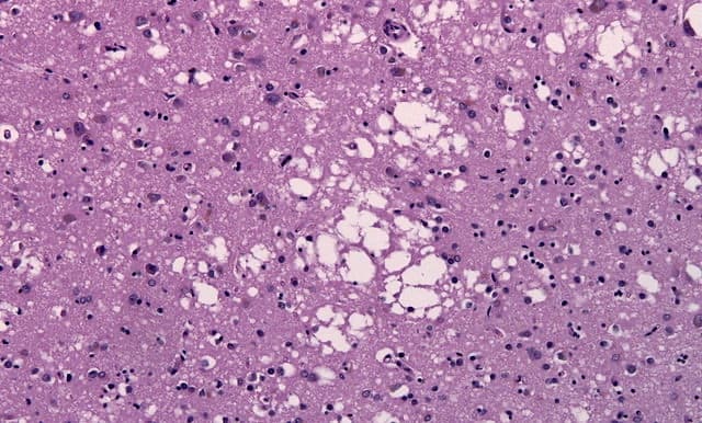 Discovery illuminates how brain cells die in prion diseases