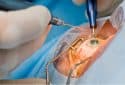 Cataract surgery linked with lessened dementia risk