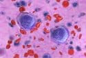 Illustration of acute myeloid leukemia cells in blood.