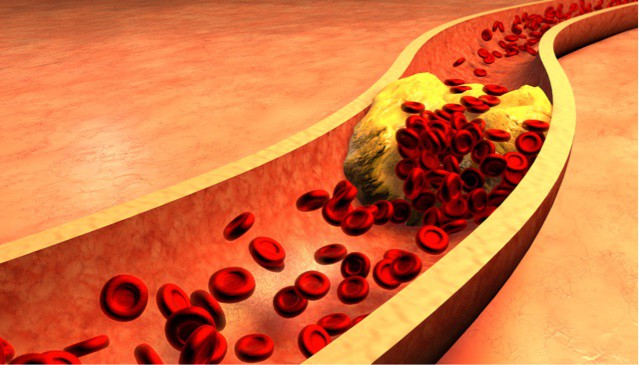 Macrophages in the artery wall ‘smell’ their surroundings