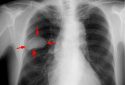 small-cell lung cancer tumor in chest X-ray
