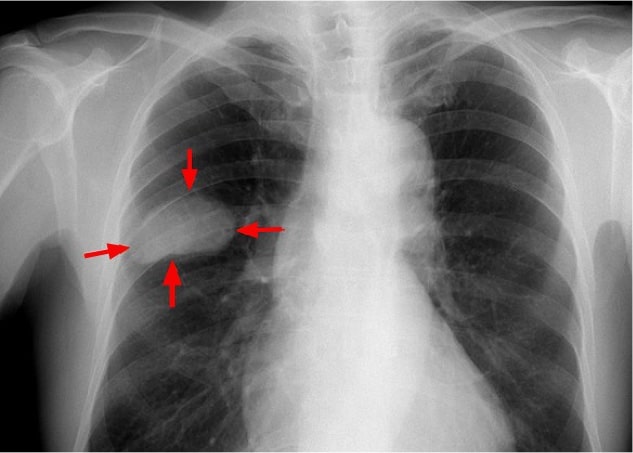 small-cell lung cancer tumor in chest X-ray