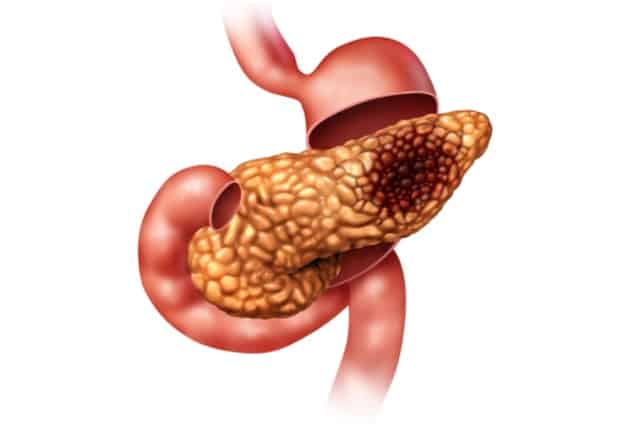Pancreatic cancer illustration