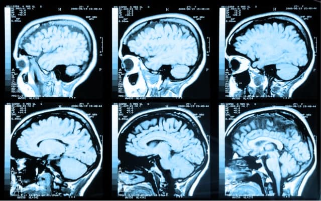 brain scan, brain imaging