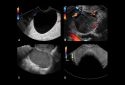 ovarian cancer ultrasound images