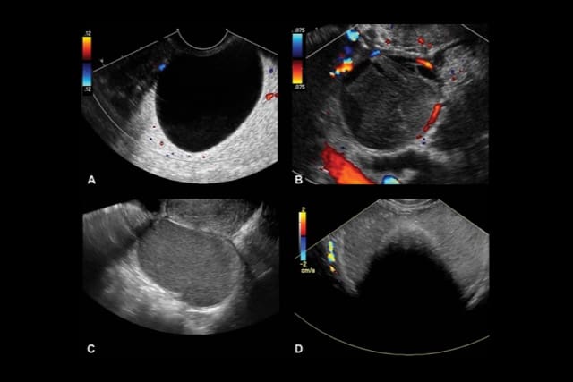 ovarian cancer ultrasound images
