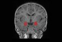 Amygdala overgrowth in babies who later develop autism