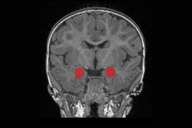 MRI brain scan showing location of amygdala.