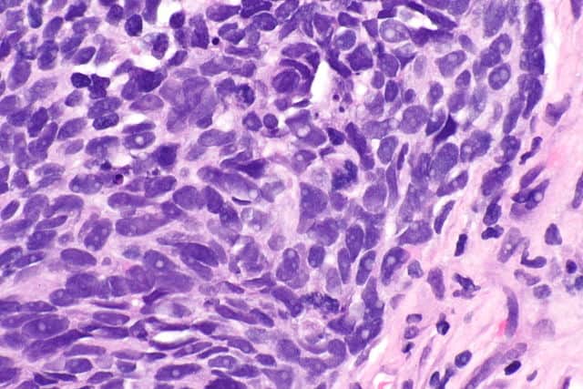 Micrograph showing a non-small cell lung carcinoma.