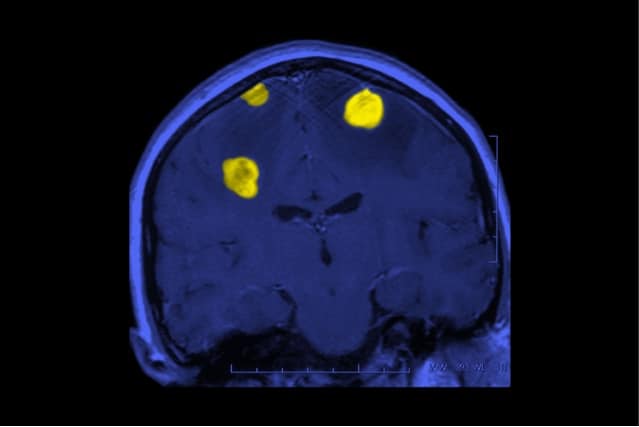 Epigenetic study provides new insights into the origins of glioma