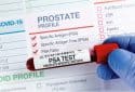 Prostate-specific antigen (PSA) test